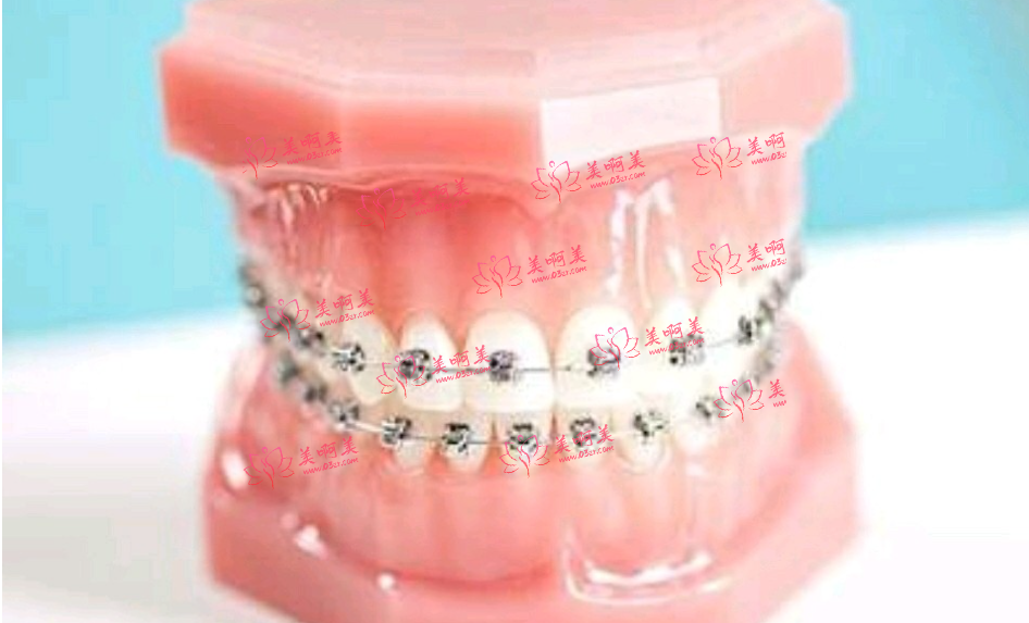 金属托槽矫正器