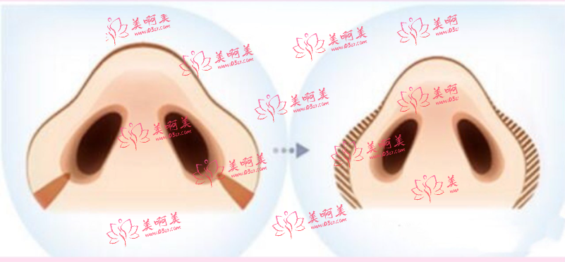 鼻翼内切的原理是什么？切口在哪里？术后需要注意什么？