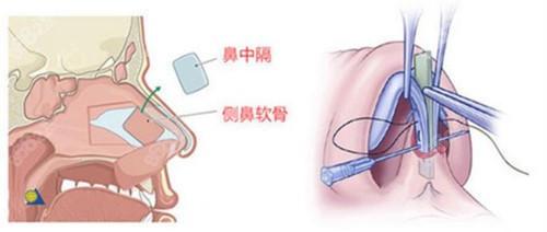 2023年吉安市鼻缺损修复整形医院,鼻缺损修复相关疑惑解答 2023年吉安市鼻缺损修复整形医院,鼻缺损修复相关疑惑解答