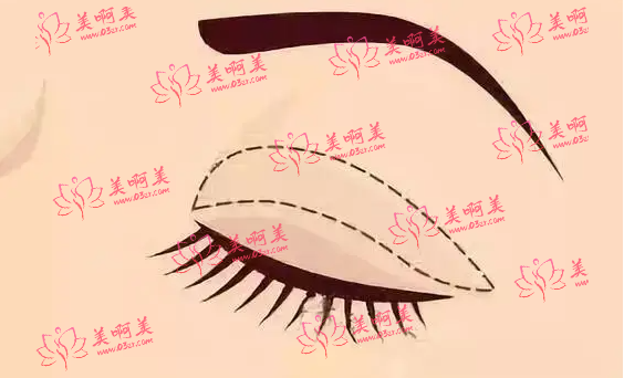 乌鲁木齐做双眼皮可以选择丽都医疗美容院吗? 乌鲁木齐做双眼皮可以选择丽都医疗美容院吗?