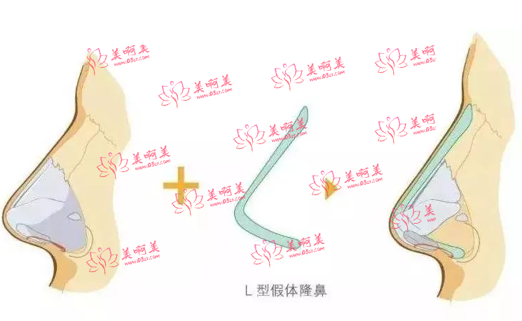 可以去临淄区人民医院整形外科做假体隆鼻吗? 可以去临淄区人民医院整形外科做假体隆鼻吗?