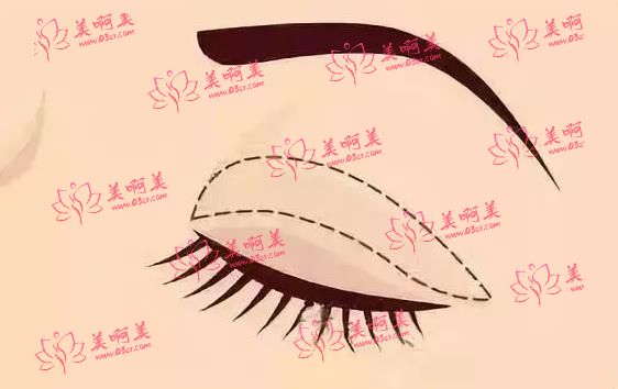 深圳阳光整形医院做双眼皮医生技术怎样？案例分享