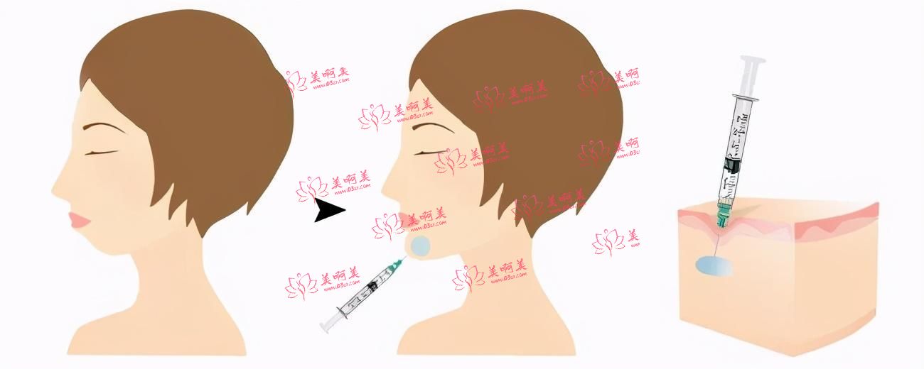 西安自体脂肪丰下巴填充价格影响因素大揭秘!材料选择、成功率展示 西安自体脂肪丰下巴填充价格影响因素大揭秘!材料选择、成功率展示