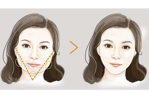 华美人气整形专家何才伟的下颌角整形案例分享，你是否也有同样的困扰！