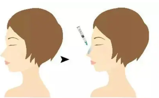 隆鼻有哪些方式?修复可以怎么办?玻尿酸隆鼻、假体隆鼻都是不错的选择! 隆鼻有哪些方式?修复可以怎么办?玻尿酸隆鼻、假体隆鼻都是不错的选择!