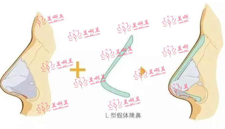 隆鼻有哪些方式?修复可以怎么办?玻尿酸隆鼻、假体隆鼻都是不错的选择! 隆鼻有哪些方式?修复可以怎么办?玻尿酸隆鼻、假体隆鼻都是不错的选择!