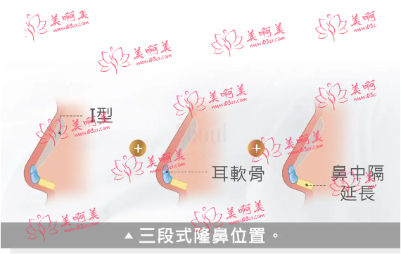 遵义三段式硅胶隆鼻手术价格贵吗？与什么因素有关？