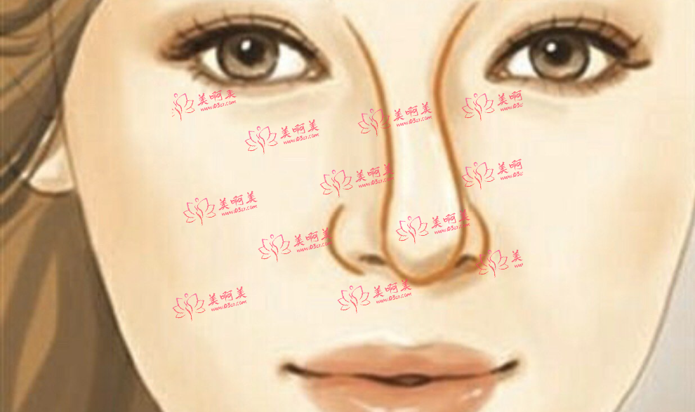 歪鼻矫正手术后还会反弹吗?术后需要注意些什么? 歪鼻矫正手术后还会反弹吗?术后需要注意些什么?