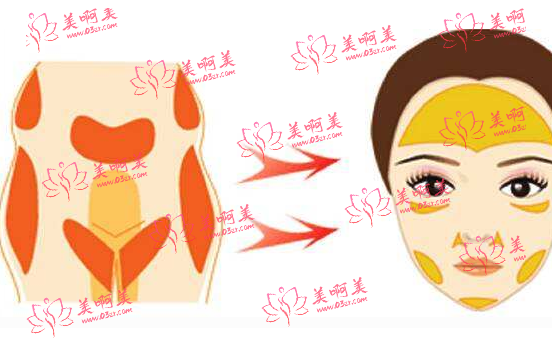 上海魏皎医生怎么样?脂肪填充价格及案例分享! 上海魏皎医生怎么样?脂肪填充价格及案例分享!