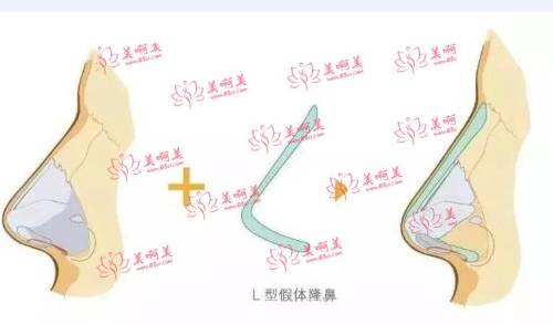 营口协和价格表公开！鼻部整形价格最低1500元，实惠技术好！