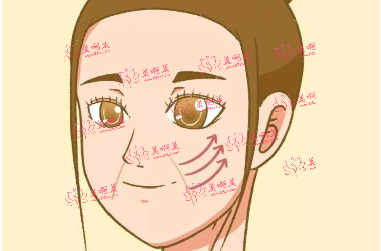 自体脂肪去法令纹的维持时间有多久?手术有什么优缺点吗? 自体脂肪去法令纹的维持时间有多久?手术有什么优缺点吗?