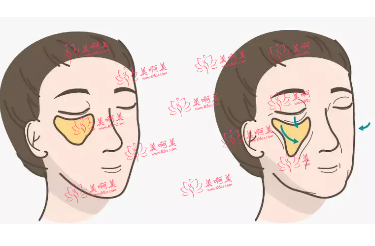 自体脂肪去法令纹的维持时间有多久?手术有什么优缺点吗? 自体脂肪去法令纹的维持时间有多久?手术有什么优缺点吗?