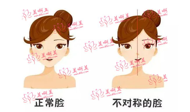 面部不对称(脸歪)怎么矫正?带你全面了解矫正脸型不对称的方法 面部不对称(脸歪)怎么矫正?带你全面了解矫正脸型不对称的方法