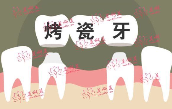 烤瓷牙会对口腔产生危害吗?烤瓷牙的价格、使用时间全面解析! 烤瓷牙会对口腔产生危害吗?烤瓷牙的价格、使用时间全面解析!