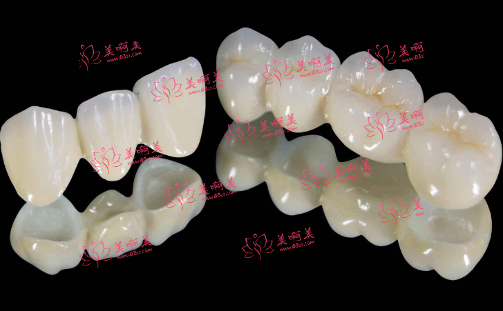 烤瓷牙和全瓷牙哪个好?来看看优缺点对比吧!还有使用时间分享 烤瓷牙和全瓷牙哪个好?来看看优缺点对比吧!还有使用时间分享