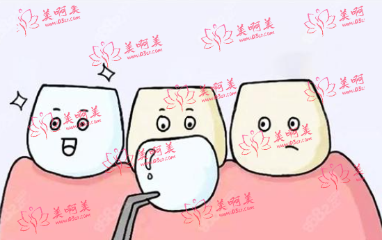 牙齿贴面修复选树脂贴面还是瓷贴面?除贴面外,还有哪些修复方式? 牙齿贴面修复选树脂贴面还是瓷贴面?除贴面外,还有哪些修复方式?