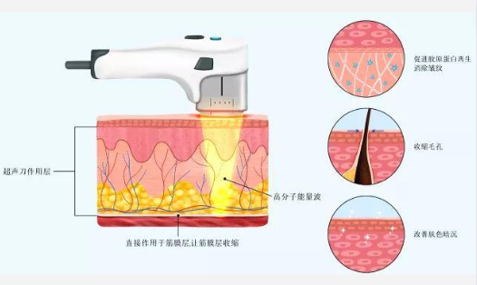 超声炮手术适合的年龄段是?超声炮作用原理、维持时间全解析! 超声炮手术适合的年龄段是?超声炮作用原理、维持时间全解析!