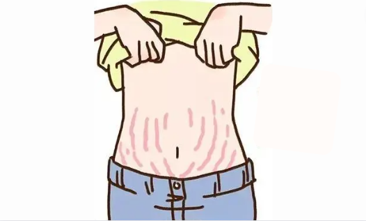 激光去妊娠纹有效果吗?很多年的能去掉吗?价格贵不贵? 激光去妊娠纹有效果吗?很多年的能去掉吗?价格贵不贵?