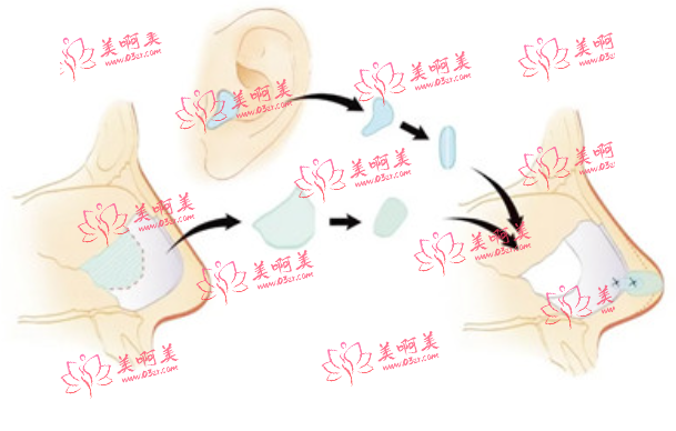 广州可玉肋软骨隆鼻怎么样？医生技术靠谱价格也不贵！