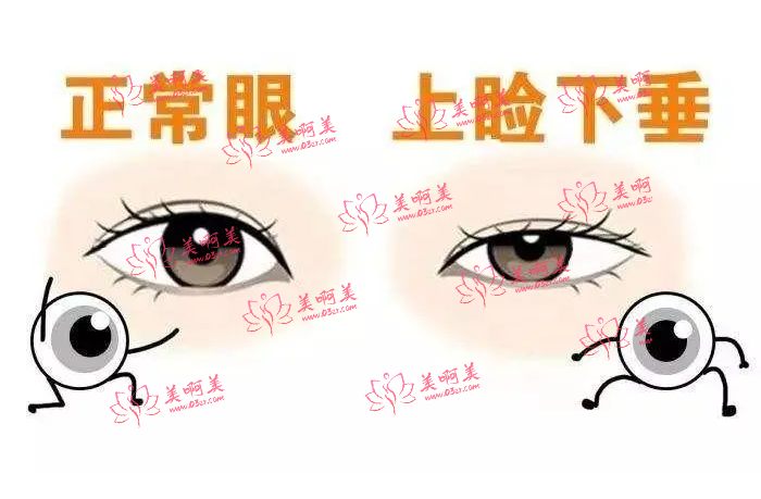 上海九院究竟好在哪里?揭秘王琛医生的上睑下垂技术! 上海九院究竟好在哪里?揭秘王琛医生的上睑下垂技术!