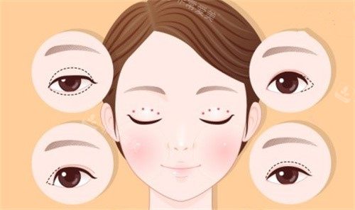 长沙雅美医院怎么样？正规吗？双眼皮技术如何？