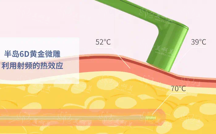 黄金微雕吸脂和普通吸脂区别对比：原理、优势、效果等多方面比较！