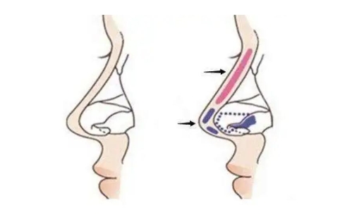 北京京美医疗美容隆鼻技术实力简介：特色优势一览，口碑反馈分享