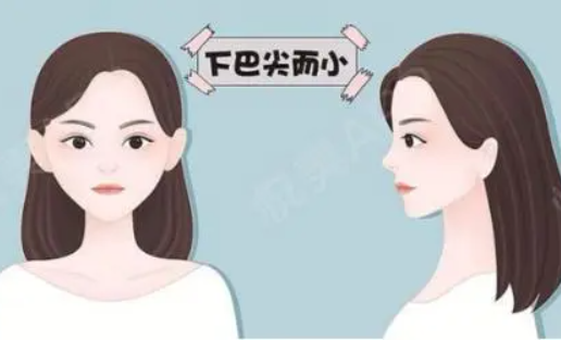 丰下巴的手术方式有哪些?适合人群、术前准备全面解析! 丰下巴的手术方式有哪些?适合人群、术前准备全面解析!