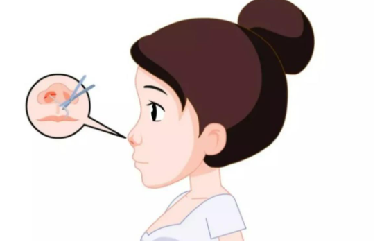 北京嘉禾妇儿医院隆鼻手术多少钱?技术优势、真实案例分享! 北京嘉禾妇儿医院隆鼻手术多少钱?技术优势、真实案例分享!