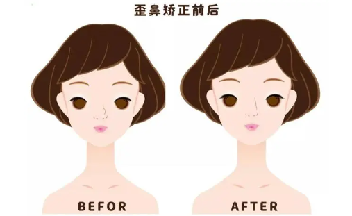 上海第九人民医院做歪鼻矫正怎么样?推荐医生+术后注意事项分享 上海第九人民医院做歪鼻矫正怎么样?推荐医生+术后注意事项分享