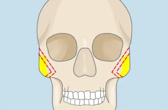 颧骨下降手术后的常见问题和解决方法