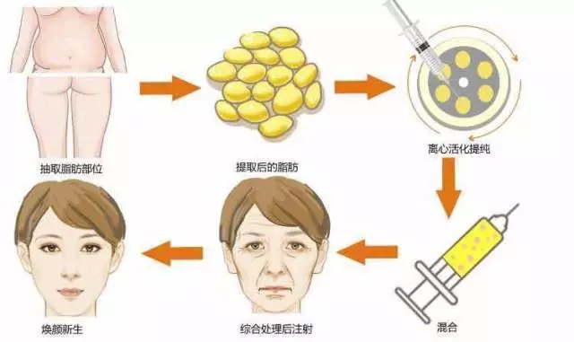 脂肪填充VS再生因子：哪种整形方法更适合你？