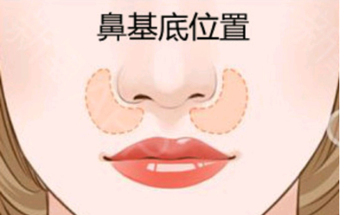 鼻基底填充用什么玻尿酸比较好?利弊全掌握，选对材质维持时间长!