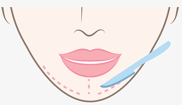 科学塑造完美下巴线条：下巴变尖手术方法及注意事项