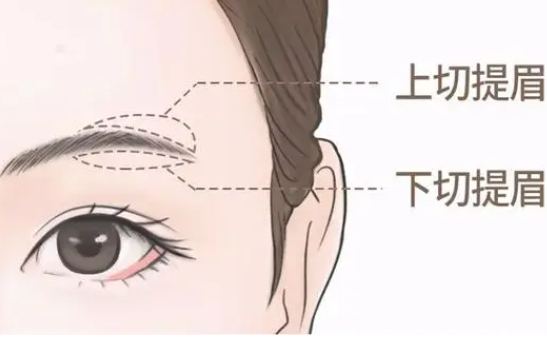 提眉手术与割双眼皮手术：恢复速度大比拼