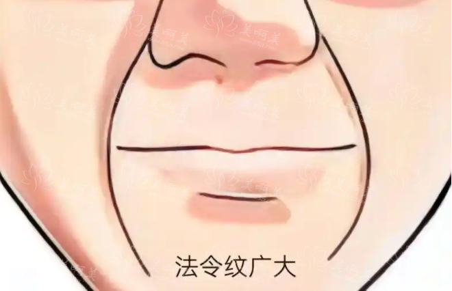面部脂肪填充法令纹：重塑青春轮廓的奇妙之旅