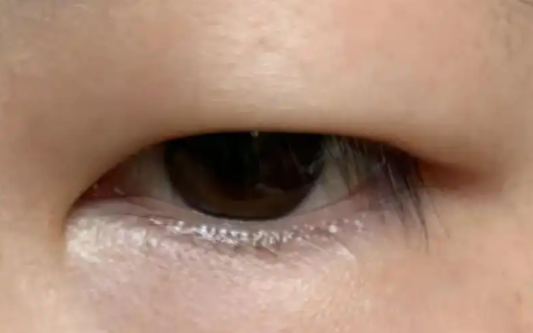 肿泡眼割双眼皮：追求自然之美的探索与实践