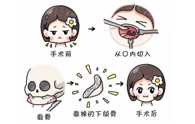 武汉中翰下颌角项目技术咋样?看看真实案例反馈就知道了! 武汉中翰下颌角项目技术咋样?看看真实案例反馈就知道了!