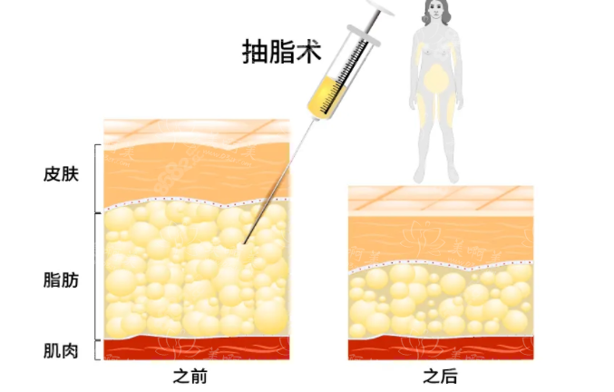 手臂抽脂手术是否需要全身麻醉？