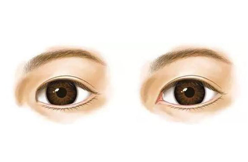 全切双眼皮手术后的护理指南