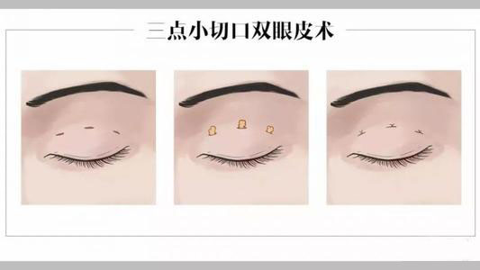 三点定位双眼皮手术能否永久保持结果?