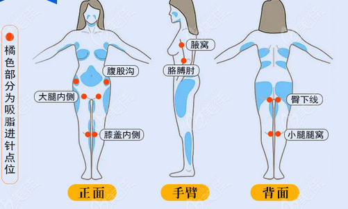 全身抽脂手术可能带来的副作用