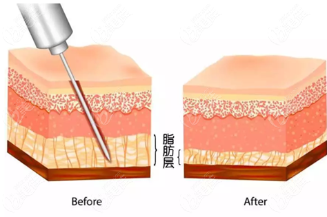 水动力吸脂的优势探析