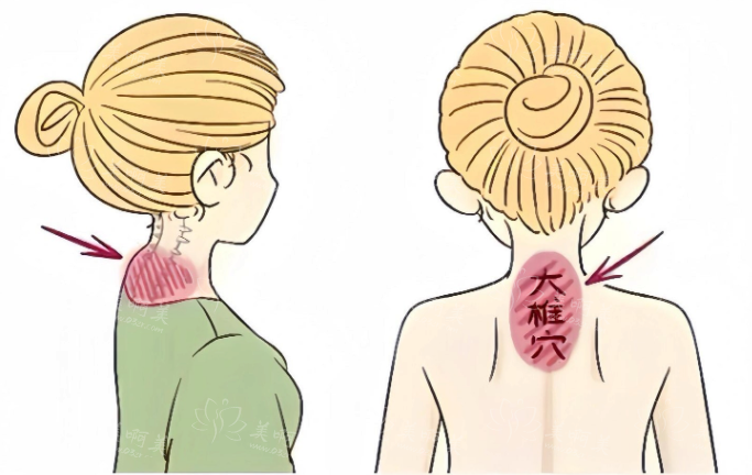 金华人民医院整形外科富贵包手术技术解析，还有真实案例一键分享！ 