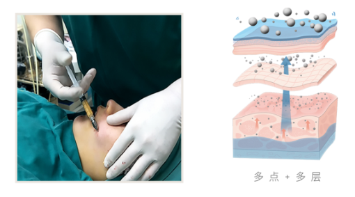 广州艺星邓晟华吸脂靠谱吗？技术特色解析一览