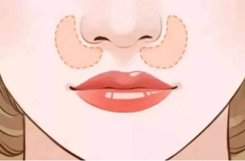 南阳市第一人民医院膨体垫鼻基底技术解析,还有案例反馈分享! 南阳市第一人民医院膨体垫鼻基底技术解析,还有案例反馈分享!