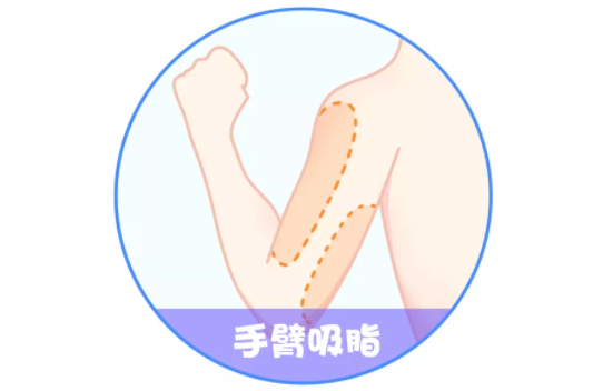 胳膊吸脂塑形：需谨慎考虑的不适宜人群