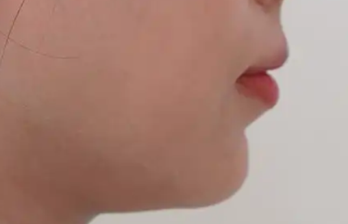 玻尿酸下巴注射：针数与维持时间全解析