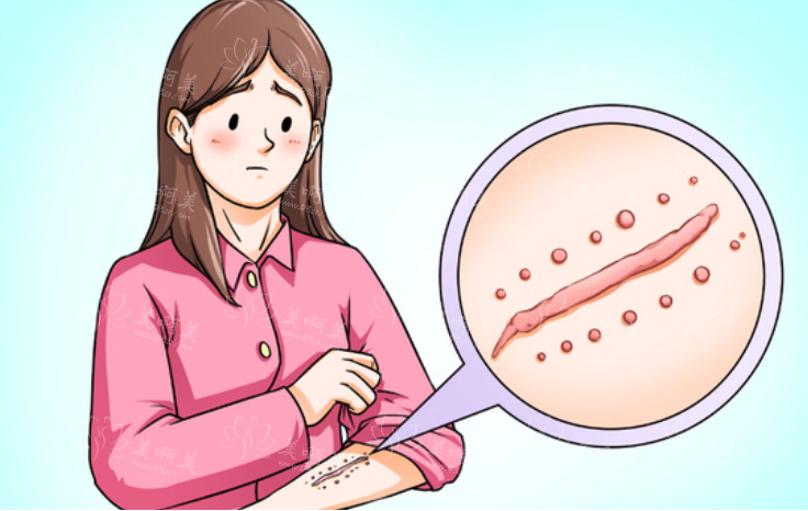 手术缝针疤痕多久才能恢复?医生解析恢复周期与科学护理要点