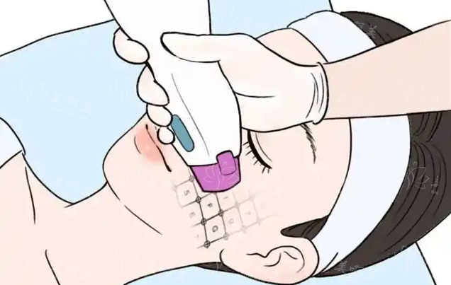 广州地区热门医院热玛吉怎么收费的?影响热玛吉项目收费的因素解析